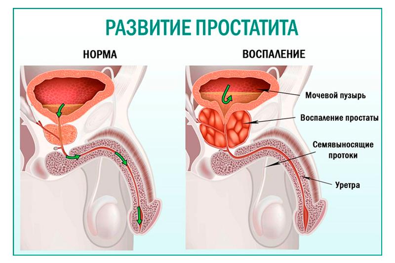 Простатит Простатит