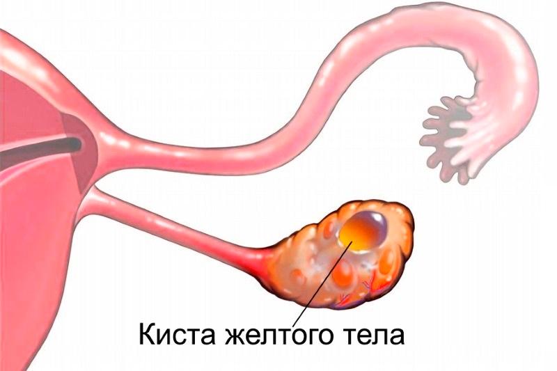 Киста желтого тела яичника