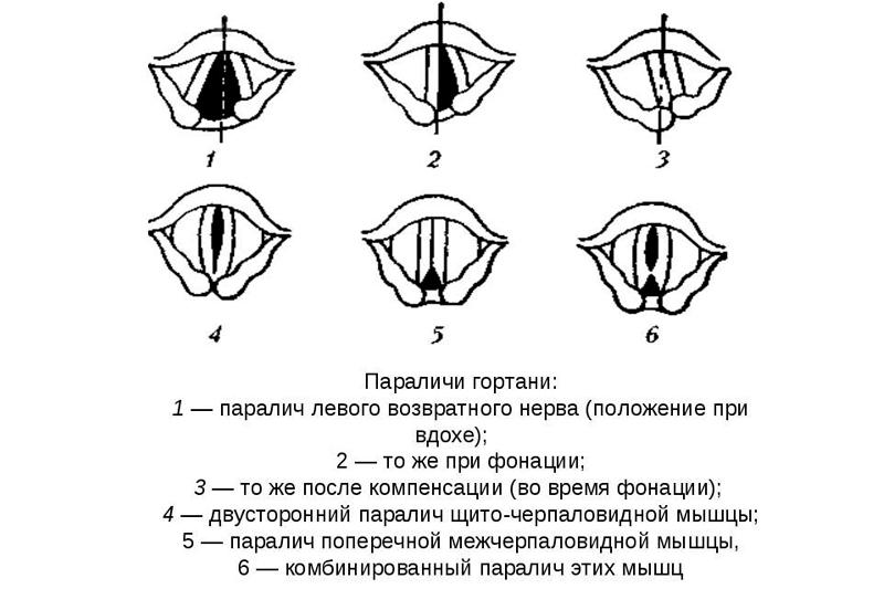 Функциональный парез гортани