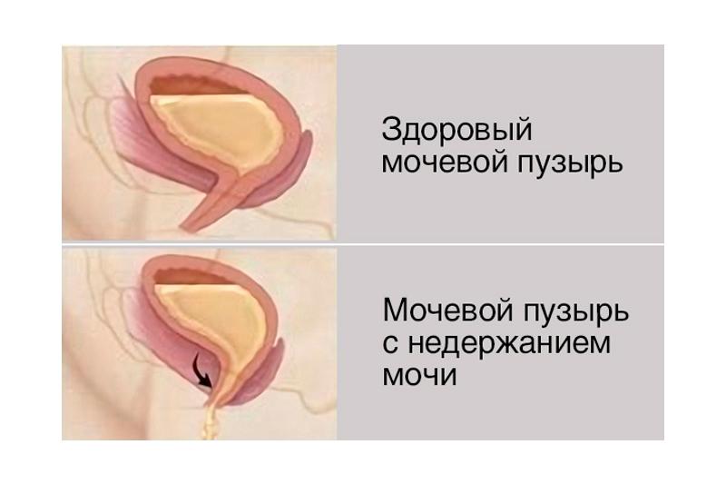 Недержание мочи Недержание мочи