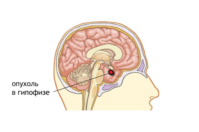 Опухоль гипофиза
