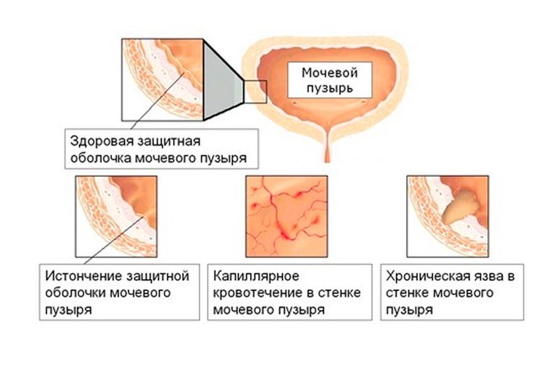 Хронический цистит