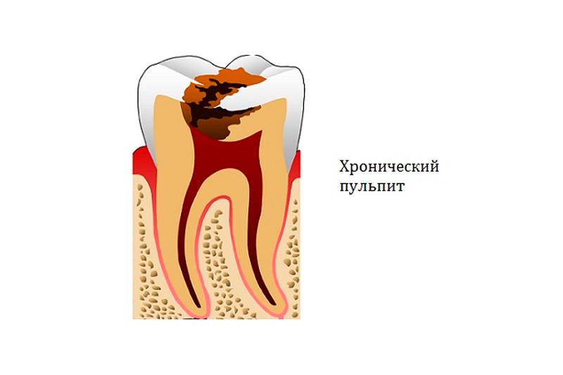 Хронический пульпит