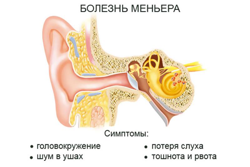 Болезнь Меньера Болезнь Меньера