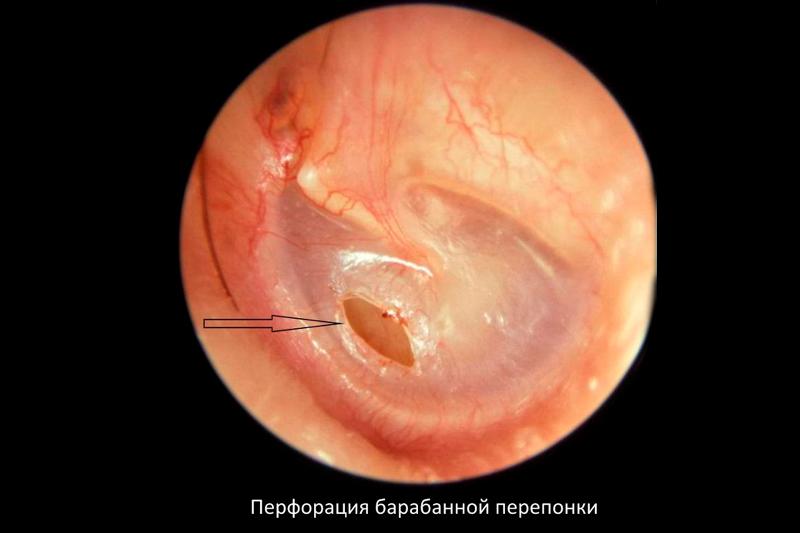 Повреждение барабанной перепонки