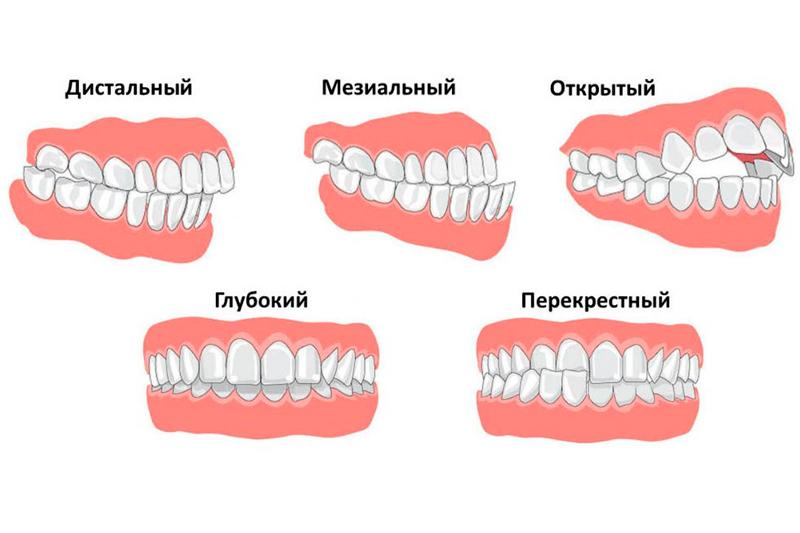 Неправильный прикус