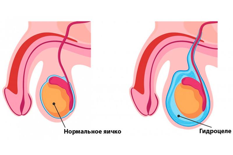 Водянка оболочек яичка Водянка оболочек яичка
