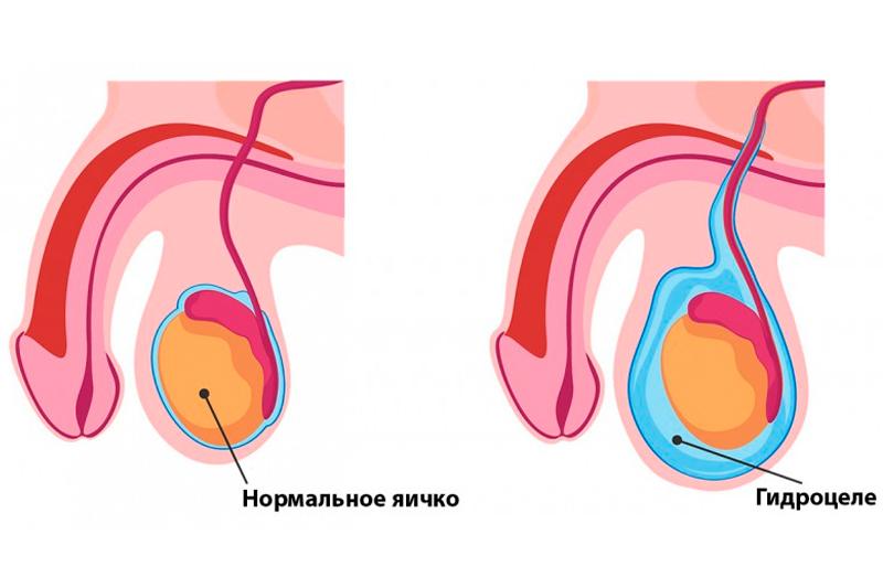 Водянка оболочек яичка