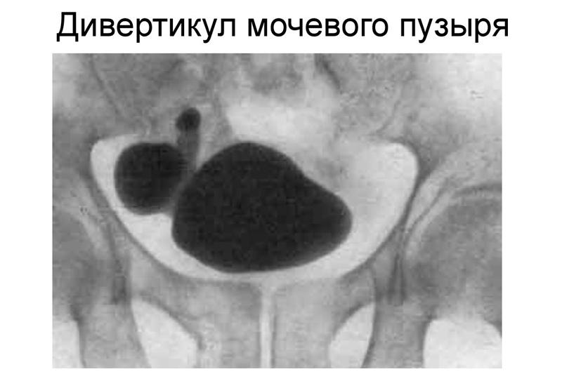 Дивертикул мочевого пузыря