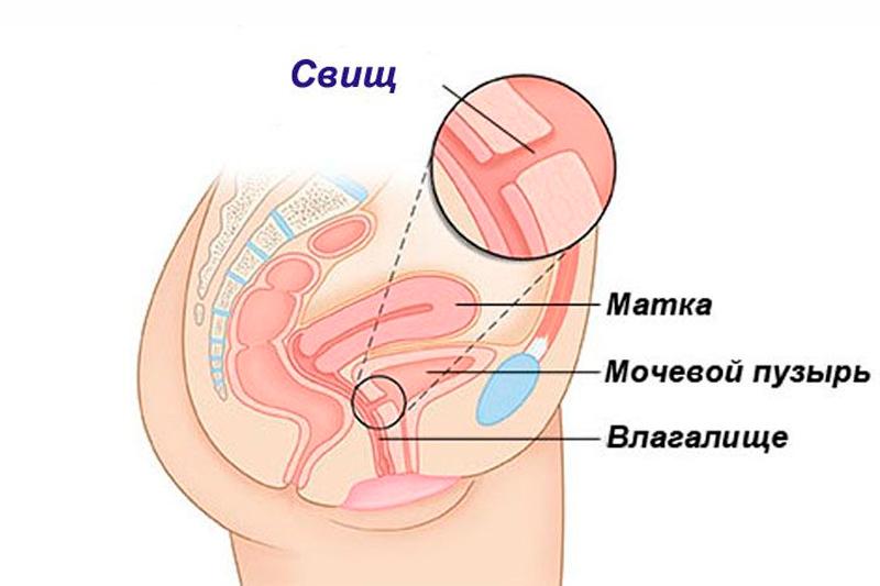 Свищи влагалища