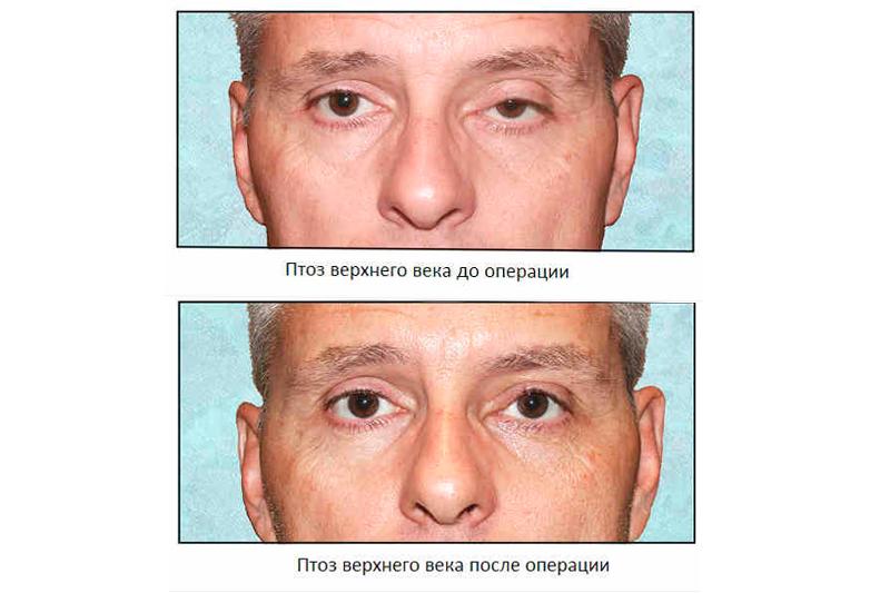 Птоз верхнего века это. Веко верхнее птоз 1 степени. Птоз верхнего века парез глазодвигательного нерва. Птоз ( опущение верхнего века. Птоз верхнего века после операции.
