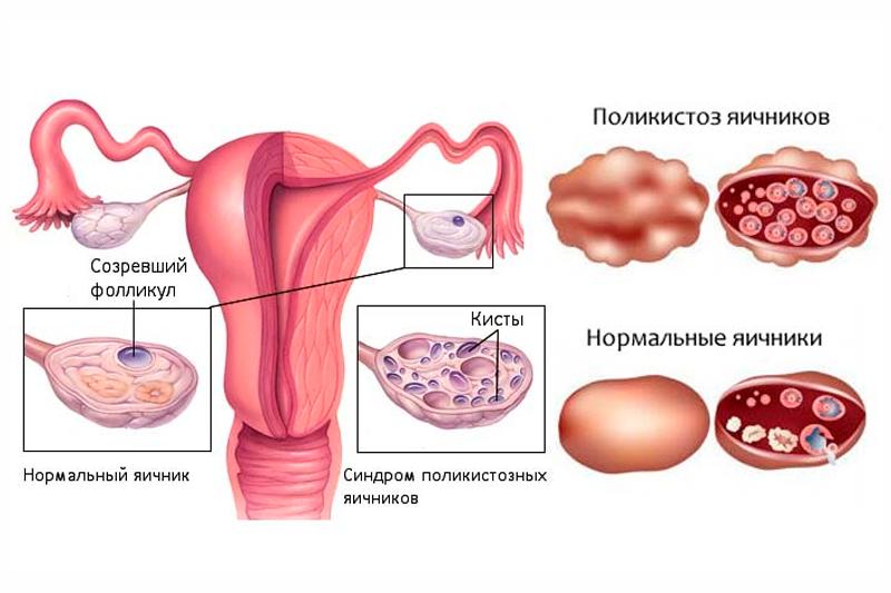 Поликистоз яичников