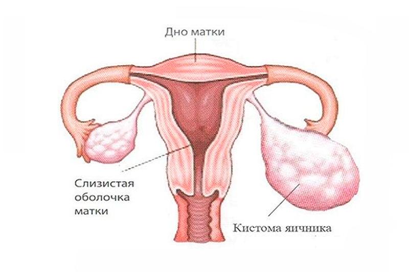 Кистома яичника Кистома яичника