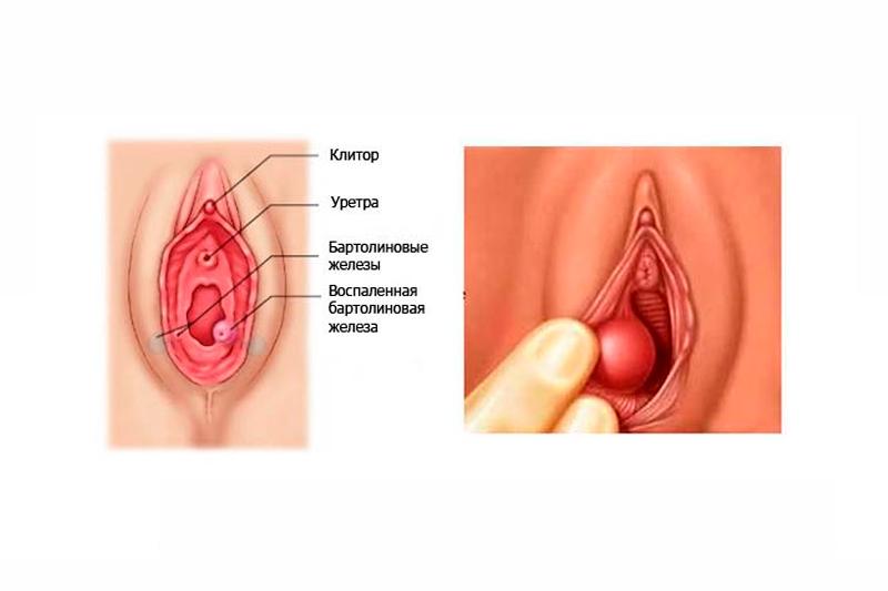 Киста влагалища