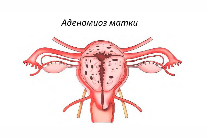 Аденомиоз Аденомиоз
