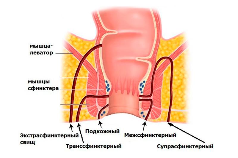 Свищи прямой кишки