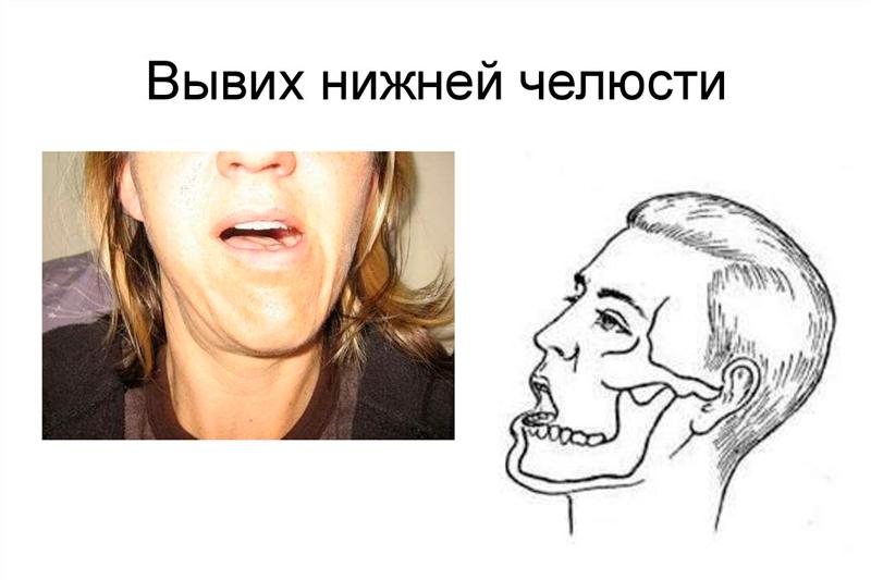Вывих нижней челюсти Вывих нижней челюсти
