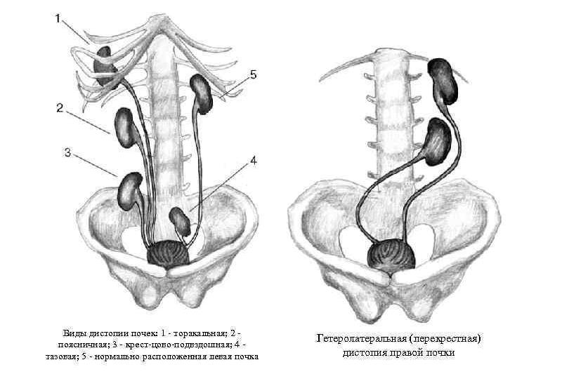 Дистопия почки