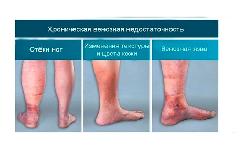 Хроническая венозная недостаточность Хроническая венозная недостаточность