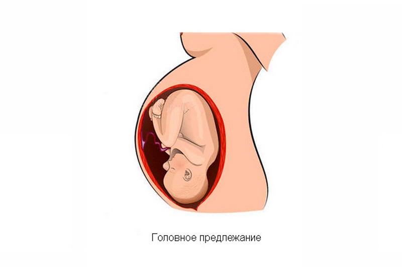 Головное предлежание плода