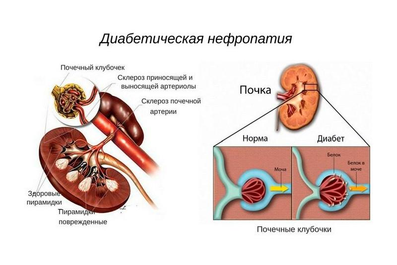 Диабетическая нефропатия