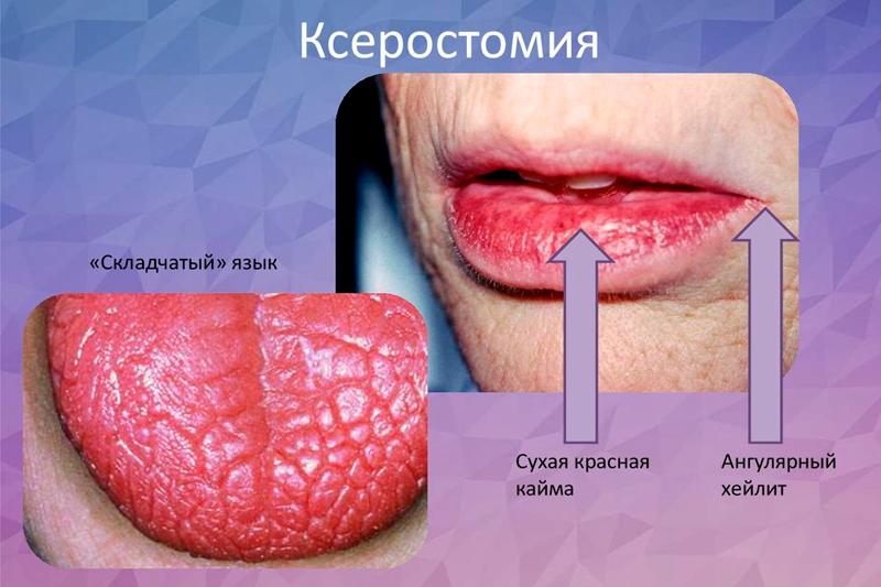Ксеростомия Ксеростомия