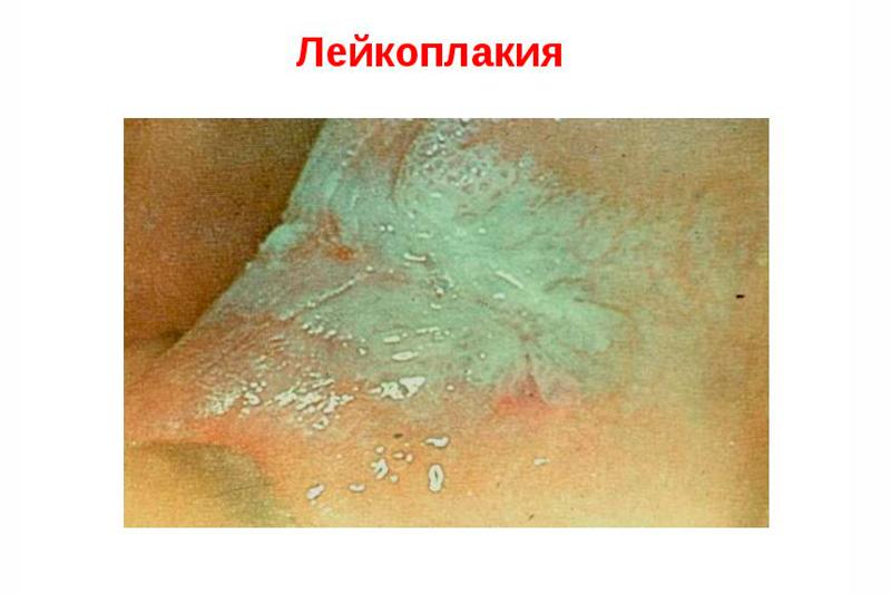 Лейкоплакия вульвы Лейкоплакия вульвы