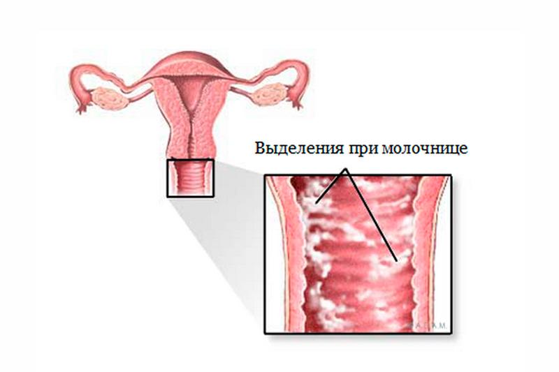 Реферат: Молочница. Симптомы молочницы.