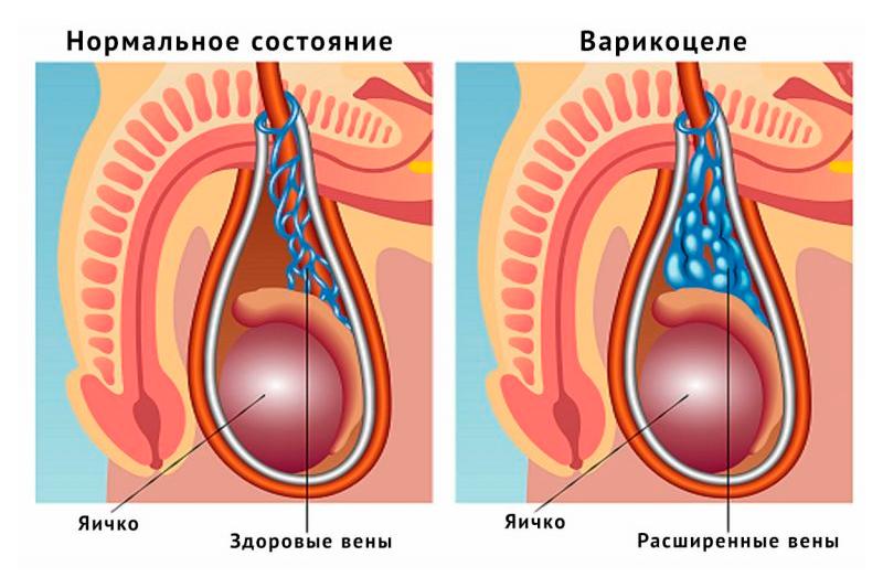 Варикоцеле яичка