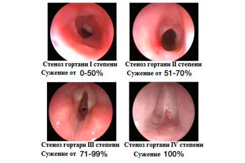 Острый стеноз гортани