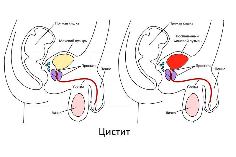 Цистит у мужчин