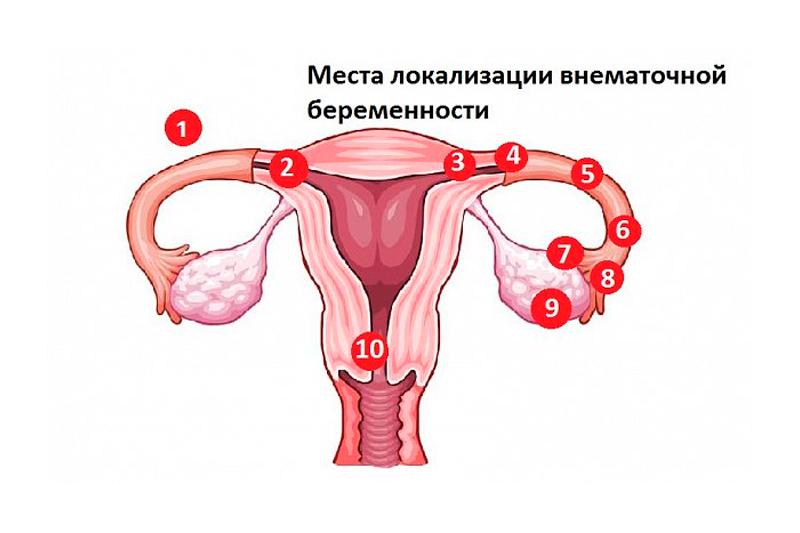 Брюшная Беременность Фото