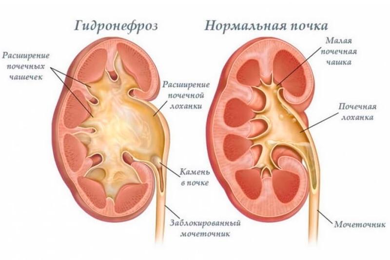 Гидронефроз