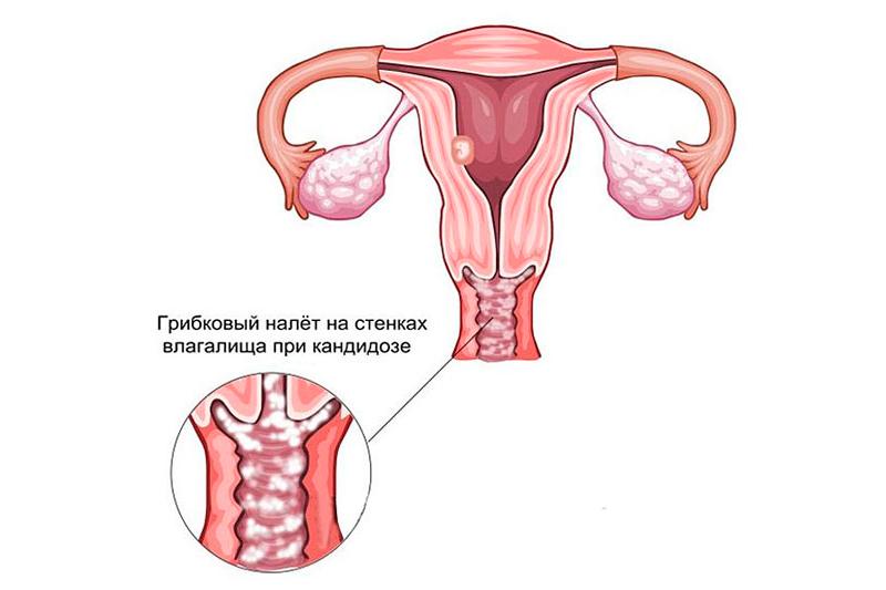 Вагинальный кандидоз