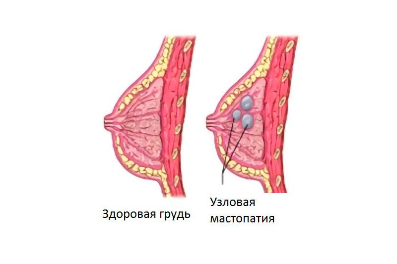 Узловая мастопатия