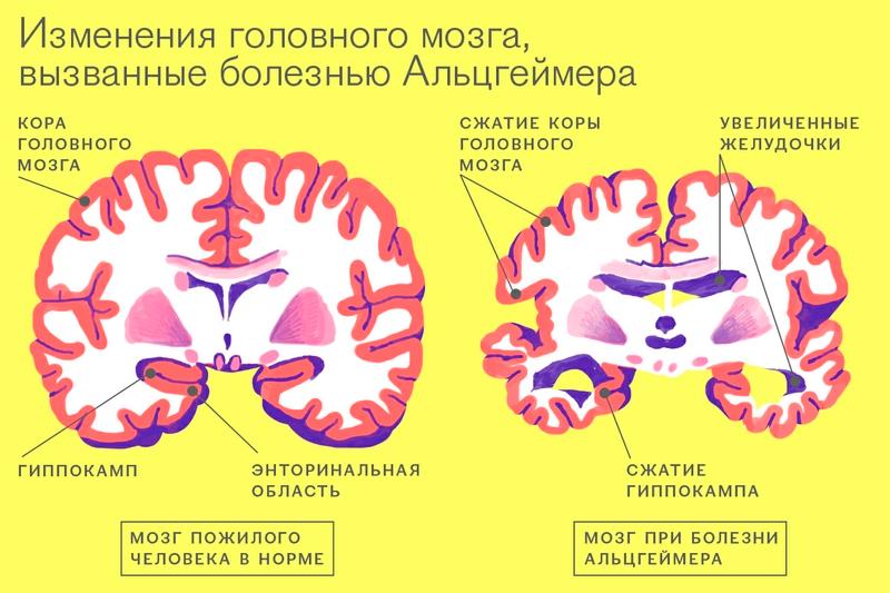 Болезнь альцгеймера этиология патогенез клиника лечение thumbnail