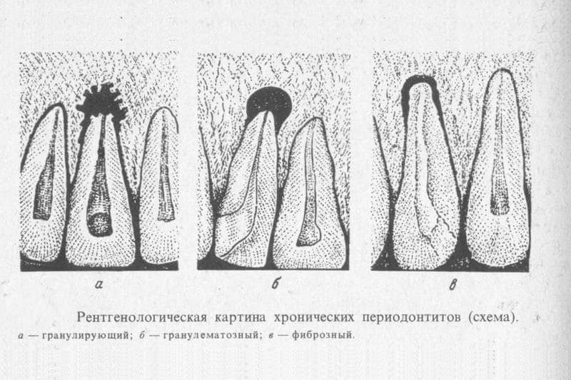 Хронический периодонтит