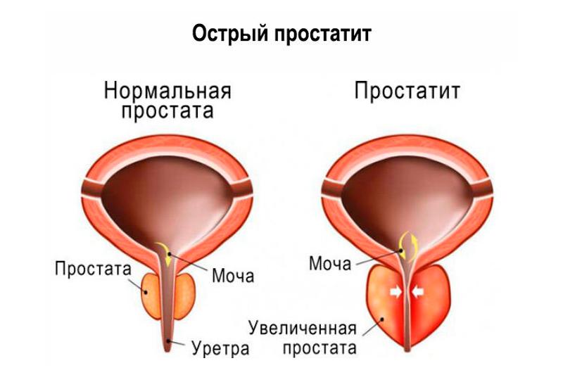 Острый простатит Острый простатит