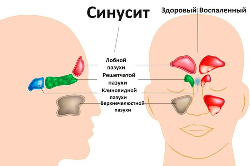 Синусит Синусит