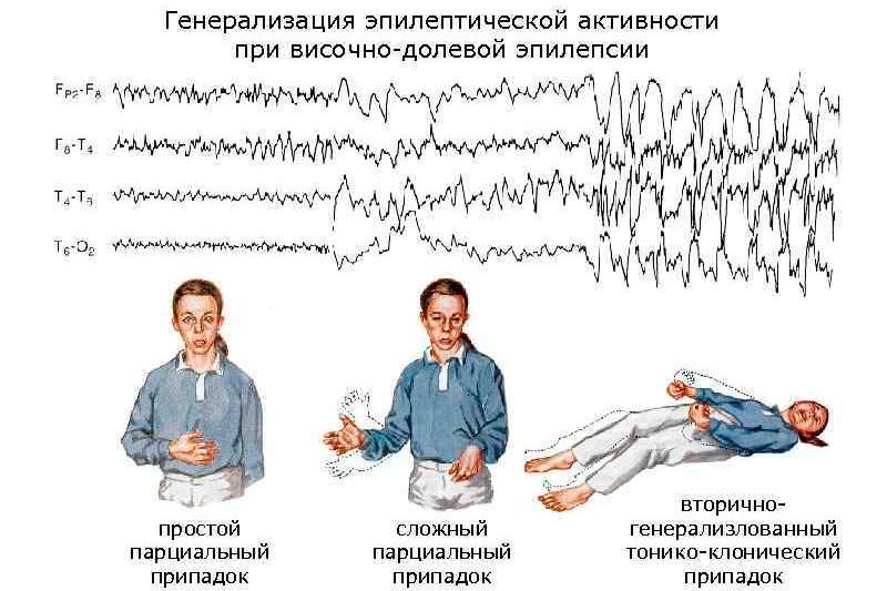 Височная эпилепсия Височная эпилепсия