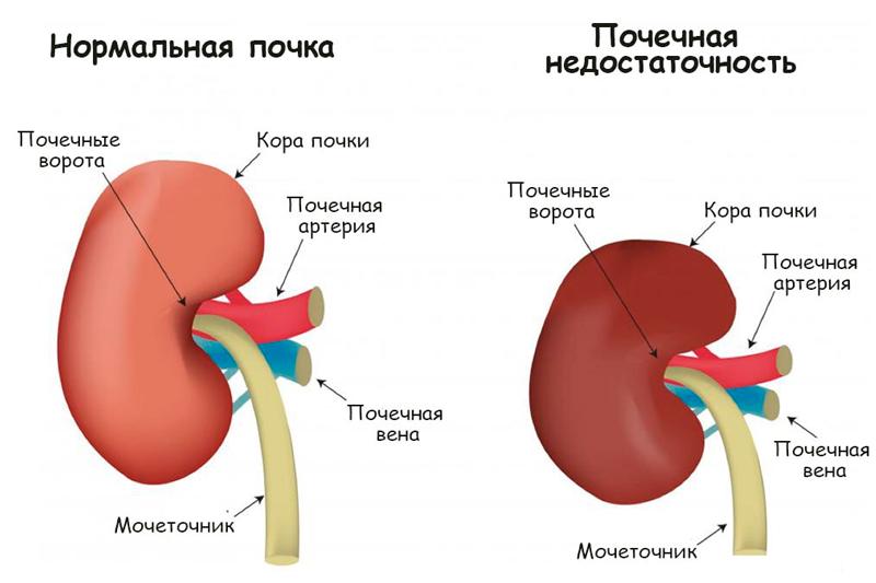 Острая почечная недостаточность