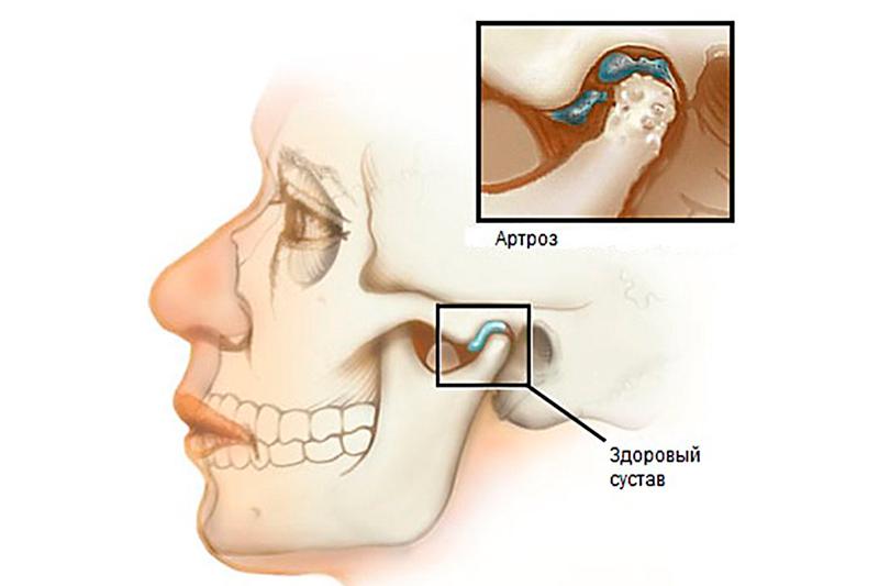 Артрозы височно нижнечелюстного сустава классификация thumbnail