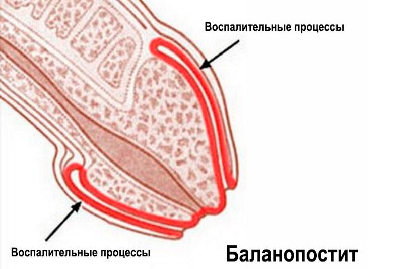 Баланопостит У Мальчика Фото