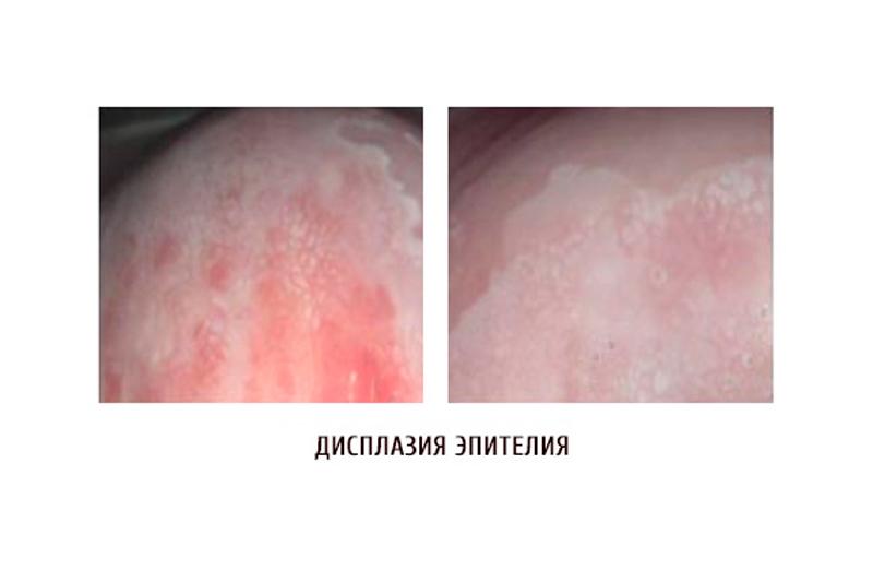 Дисплазия вульвы Дисплазия вульвы