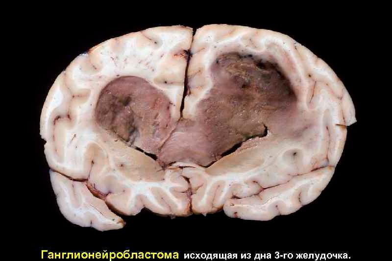 Ганглионейробластома Ганглионейробластома