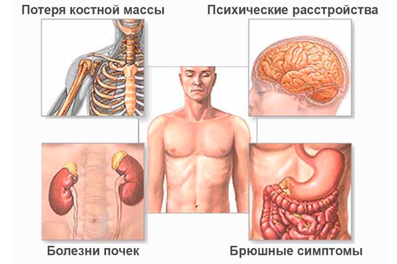 Гиперпаратиреоз