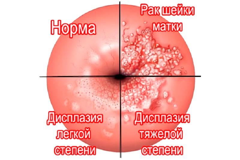 Дисплазия шейки матки