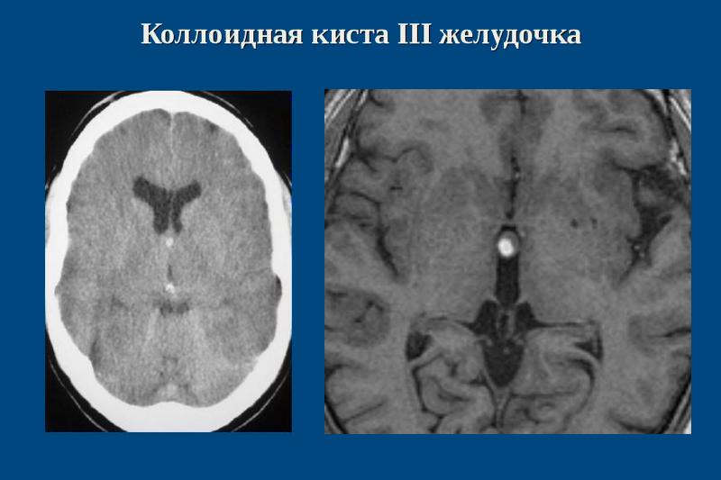 Коллоидная киста III желудочка Коллоидная киста III желудочка