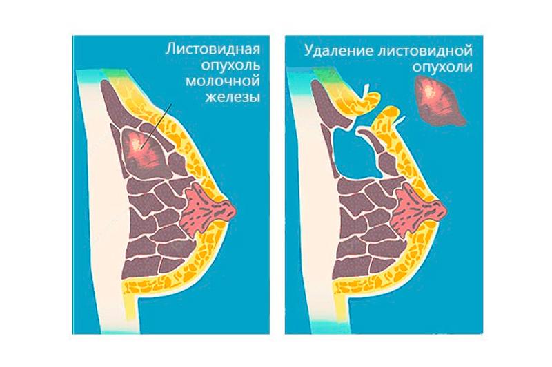 Листовидная опухоль молочной железы Листовидная опухоль молочной железы