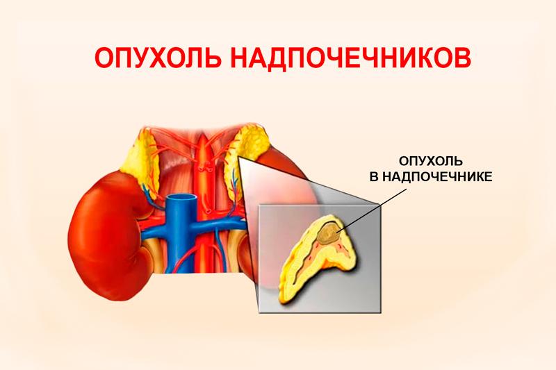 Гормонально-неактивные опухоли надпочечников